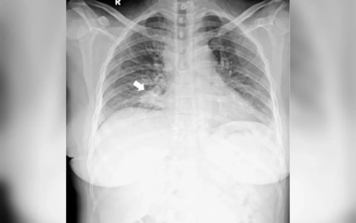 carcinoma, pulmonar;