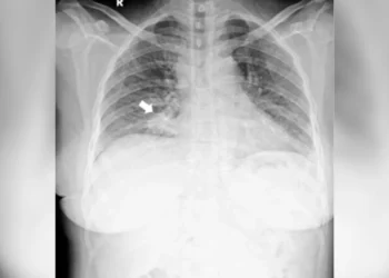 carcinoma, pulmonar;