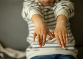 doença, viral, infecção, contagiosa, crianças, em creches;